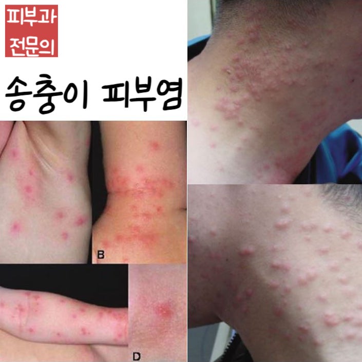 등산/산책 다녀와서 붉은 반점이 생겼어요 - 송충이 피부염(Moth caterpillar dermatitis)