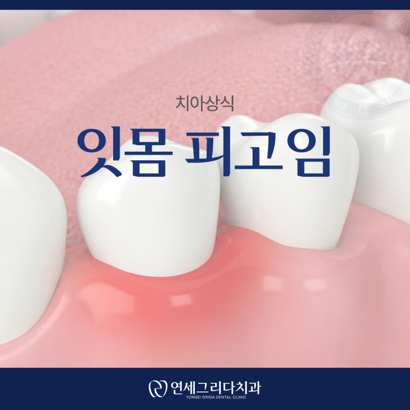 잇몸 피고임 원인은 무엇일까?