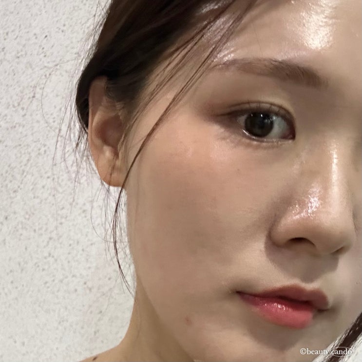  성수 뚝섬역 피부과 스킨부스터 릴리이드 피부관리 후기 히알루론산 물광주사 일주일 효과