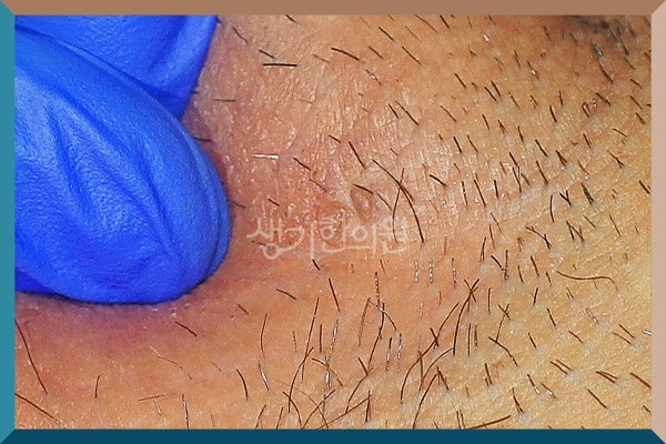 신안곤지름 통증 없어도 생길 수 있을까 초기 증상 자가 진단