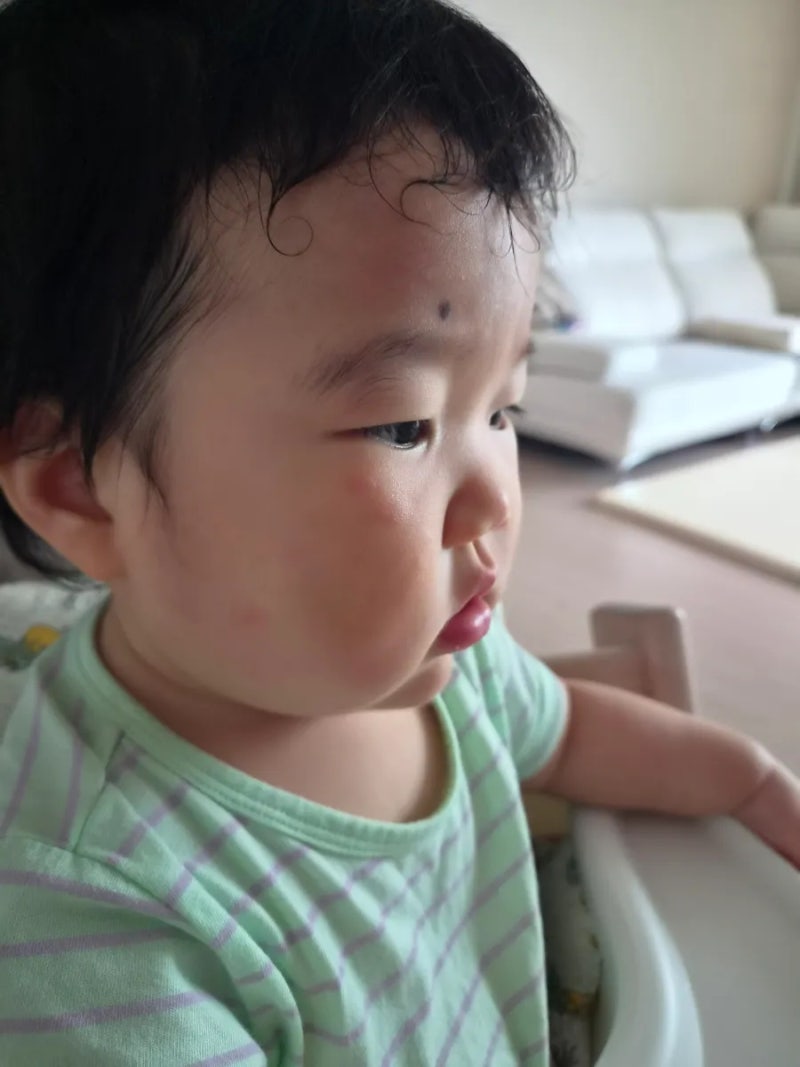(D+303~309) 10개월 아기 다형홍반 두드러기 발진 증상 및 치료 과정 (1)