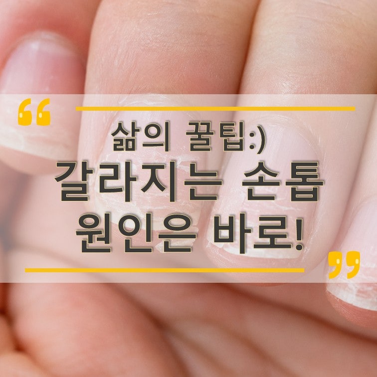 손톱끝갈라짐 원인은 바로 이것 때문! 해결관리법 알아두기