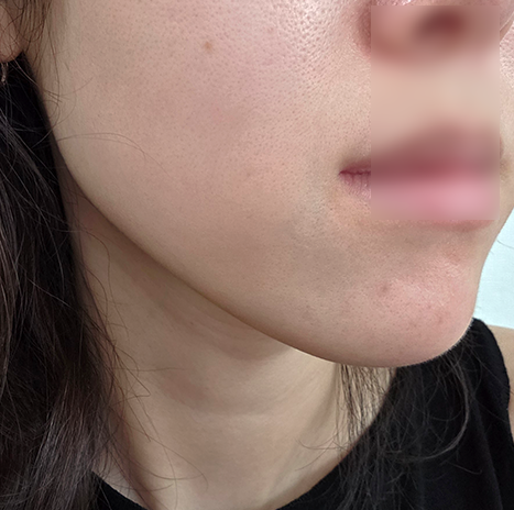 아그네스레이저 여드름에 효과본 후기 (가격, 통증)