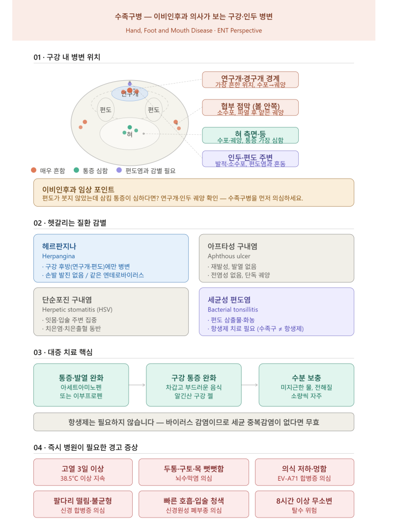 수족구병: 이비인후과 의사가 알려주는 구강·인두 병변의 모든 것