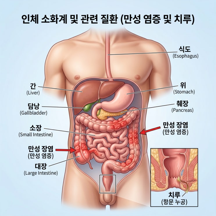   크론병 치루 완치율 1.8배 높이는 'PDRN 치료' 효과 총정리 