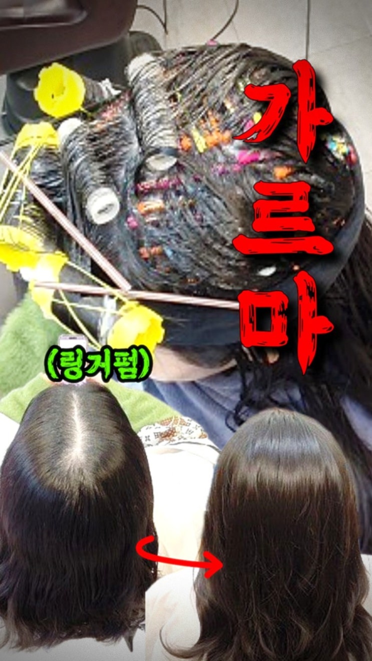  모류교정 링거펌으로 긴머리 뒤통수 갈라짐 해결! 30대 여성 가르마 교정 후기
