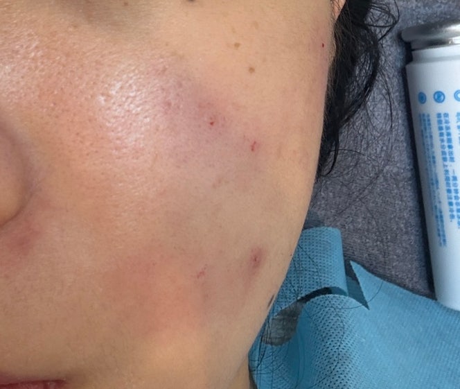  부산 서면 여드름흉터 패인흉터 새살침 내돈내산 후기(재방문후기 효과)