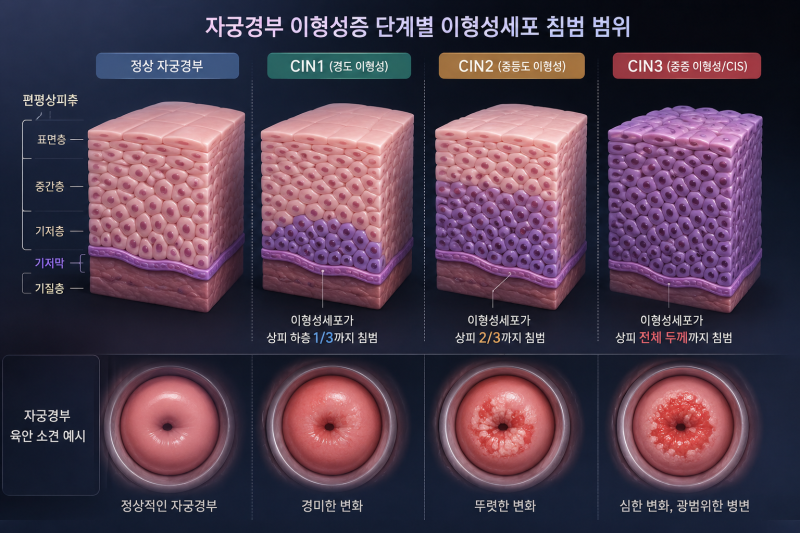 CIN1 진단 나왔다면 완치 자연치유 조건 알아보기