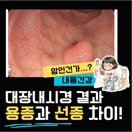 대장내시경 검사 결과 용종과 선종차이 완벽 정리 (ft. 암 발전 가능성 & 보험 청구 팁)