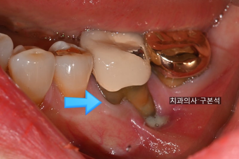 잇몸내려앉음 치료, 엠도게인과 핀홀을 활용한 잇몸재생술