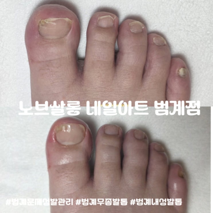 [범계문제성발관리]미뤄왔던 내성발톱 관리, 노브살롱 네일아트 범계점에서 통증 없이 관리