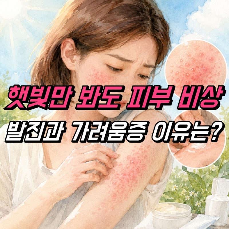 햇빛 알레르기 증상 발진 피부 가려움증, 연고 약 치료