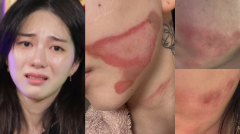 권민아, 슈링크 화상 피해 후 3500만 원 합의 결렬→병원 카톡 차단 충격 근황