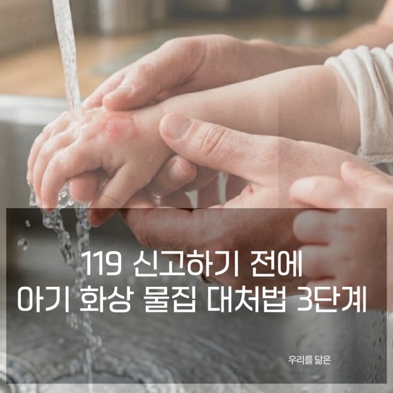 아기 화상 물집 응급처치 3단계 119 부르기 전 부모가 먼저 해야 할 것