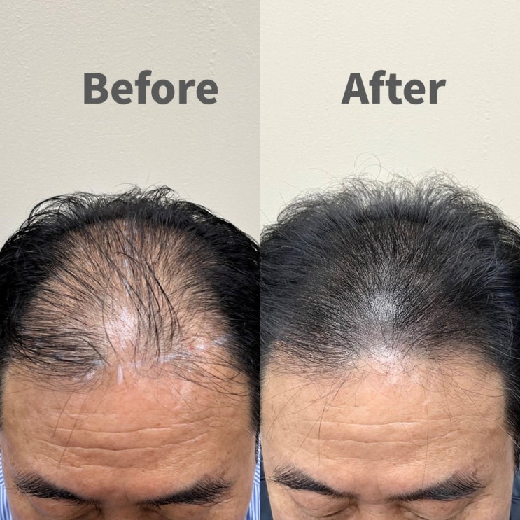  송도두피문신, 후회 없는 샵 선택을 위한 체크리스트 5가지