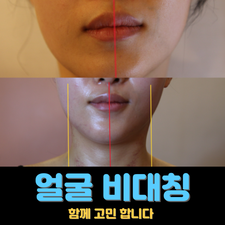  천안 신부동 얼굴비대칭, 턱선이 한쪽으로 틀어져 보일 때 윤곽관리 전 확인할것