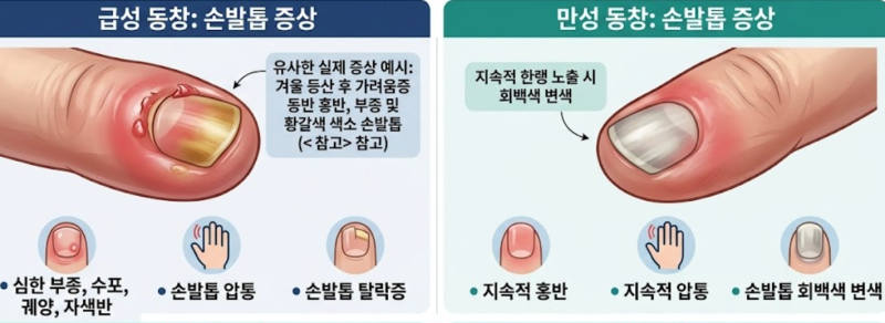 동창 과 손발톱