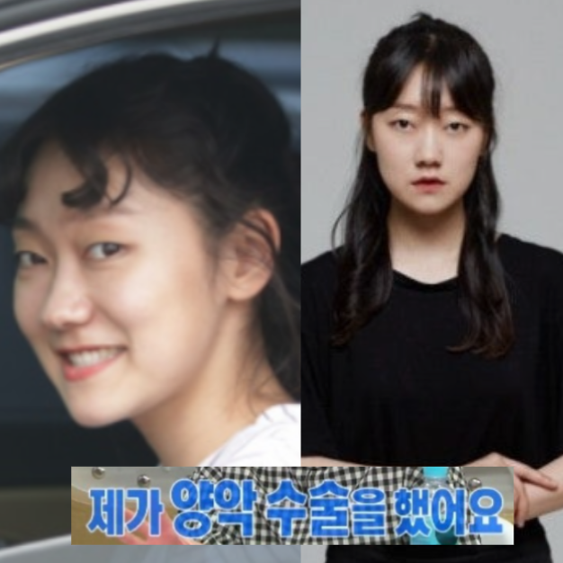 박경혜 양악수술 전후 치열 상태와 턱관절 장애 증상 유발하는 편측 저작 습관