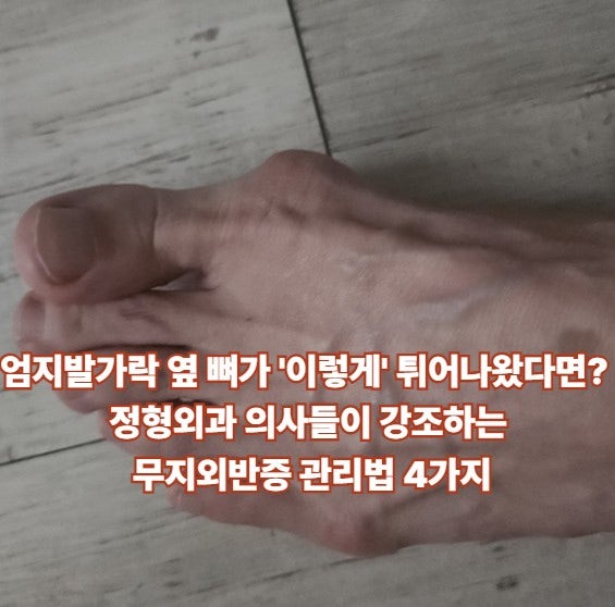 엄지발가락 옆 뼈가 '이렇게' 튀어나왔다면? 정형외과 의사들이 강조하는 무지외반증 관리법....