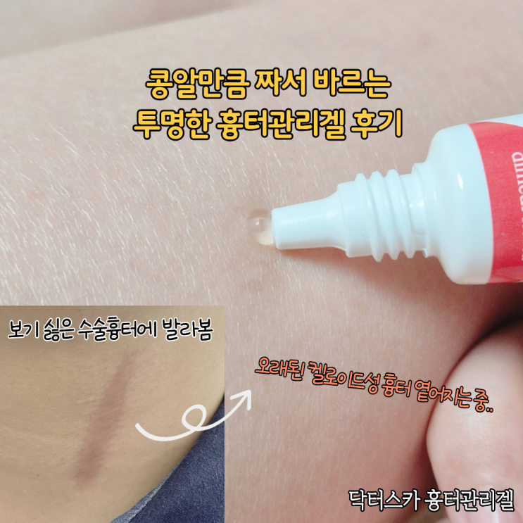  켈로이드성 흉터관리 제거용으로 발라본 닥터스카 정직한연구소 수술흉터연고 후기