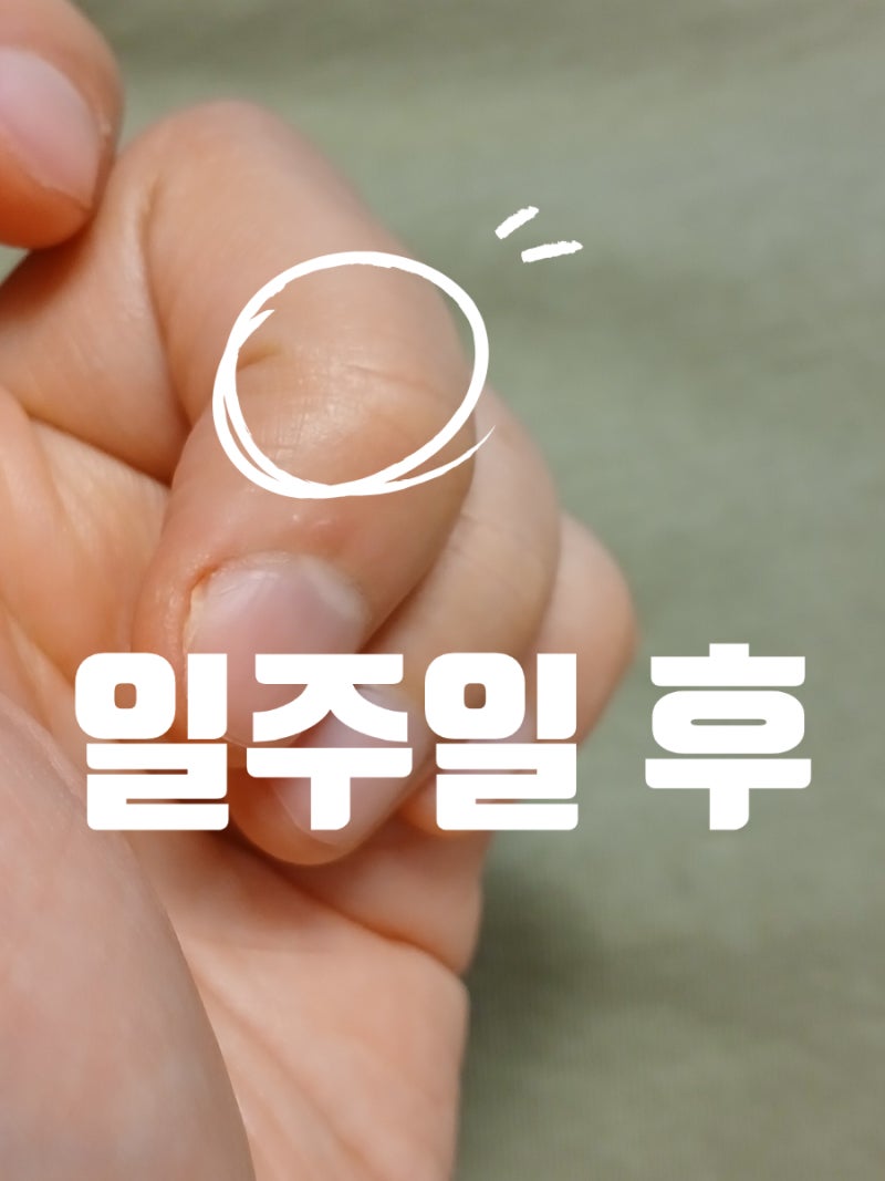 사마킬 율무크림 추천, 천연 율무 성분으로 사마귀 관리하기