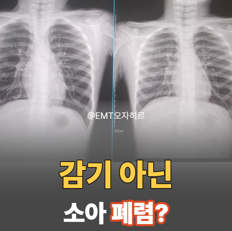 소아 폐렴 초기 증상 감기와 차이점, 마이코플라즈마 입원 기준 기간 총정리