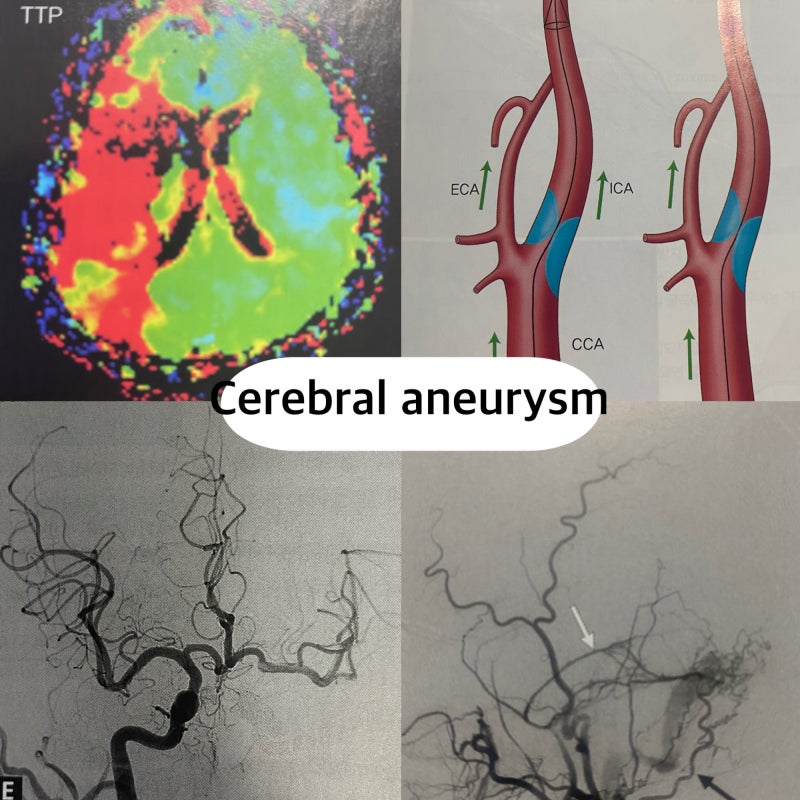 뇌동맥류 종류, Saccular vs Fusiform vs Dissecting Aneurysm