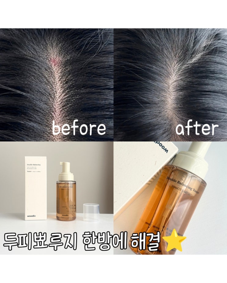  여름 두피 뾰루지 진정템 거품 두피토너 사용후기