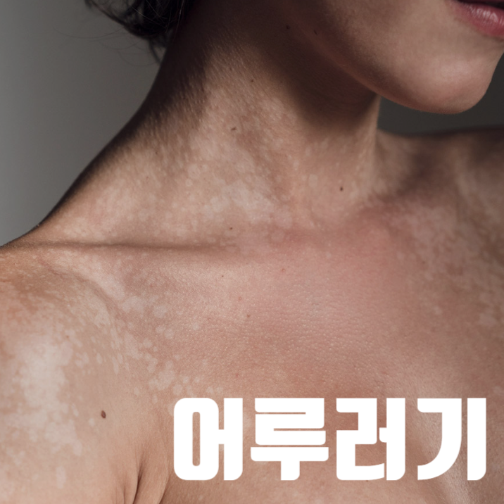 어루러기, 여름철 얼룩덜룩 피부 원인, 약국 연고 샴푸 추천, 백반증 무좀 차이