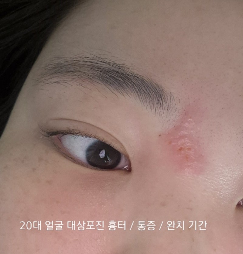 20대에 얼굴 눈 대상포진 걸린 후기｜신경통 통증, 흉터, 회복 기간 정리(신경통 레전드)