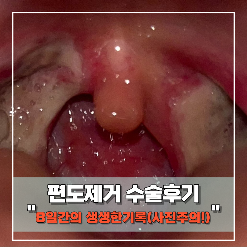 편도수술 후기 통증 총정리:편도제거수술부터 8일간의 생생한 기록 (귀 통증, 곱 냄새, 음식 ....