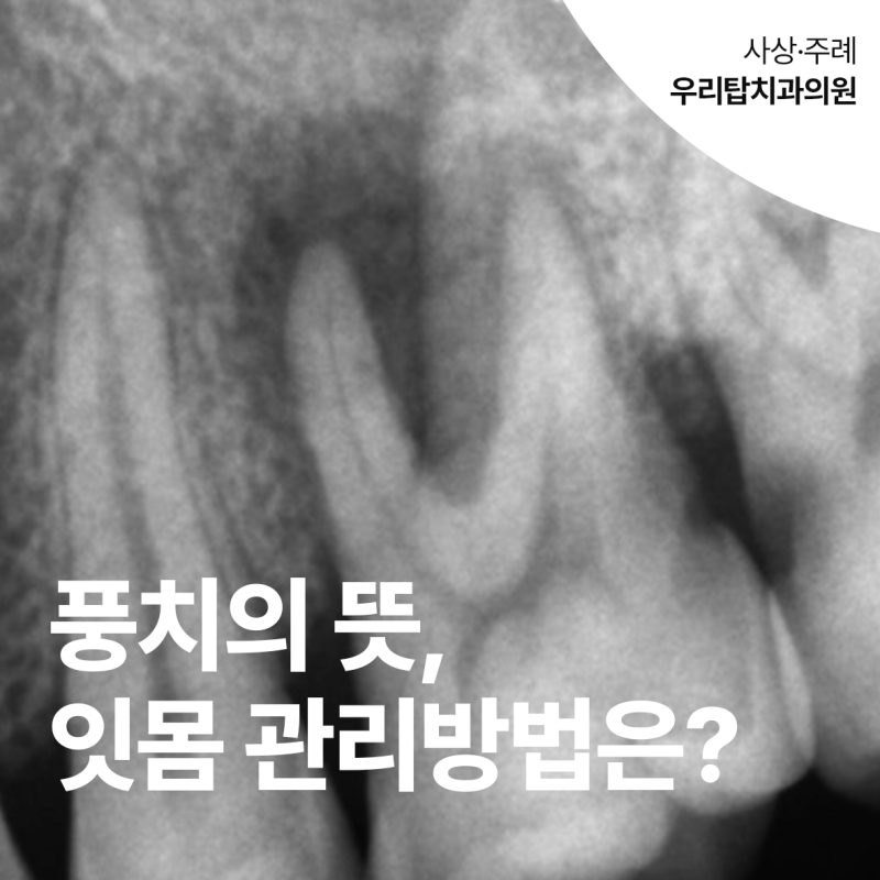 풍치 뜻과 총정리, 잇몸 관리방법