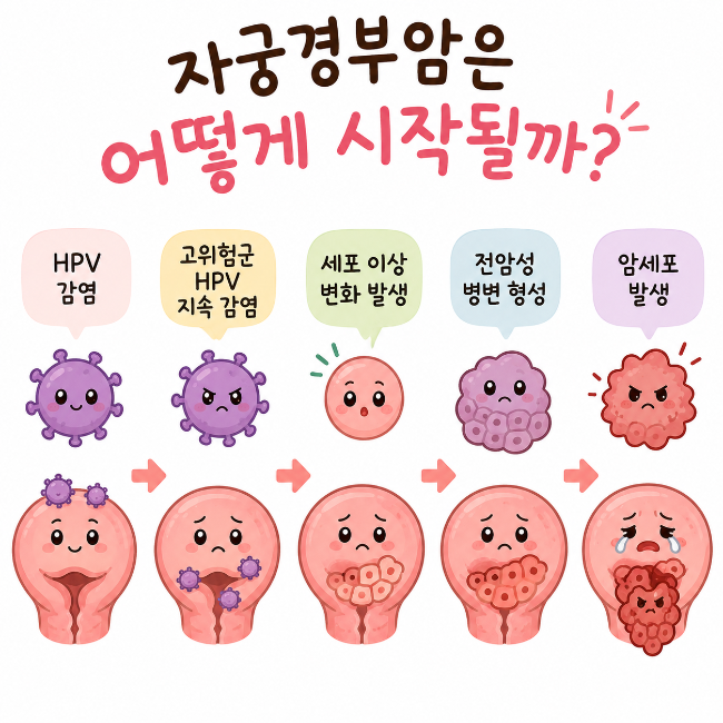 자궁경부암 단계별 진행 과정 (0기부터 4기까지 변화)