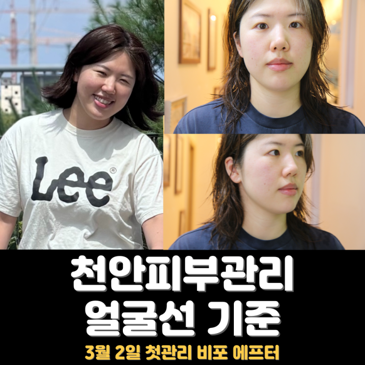  천안피부관리, 얼굴부종처럼 보이는 윤곽관리 얼굴변화 흐름
