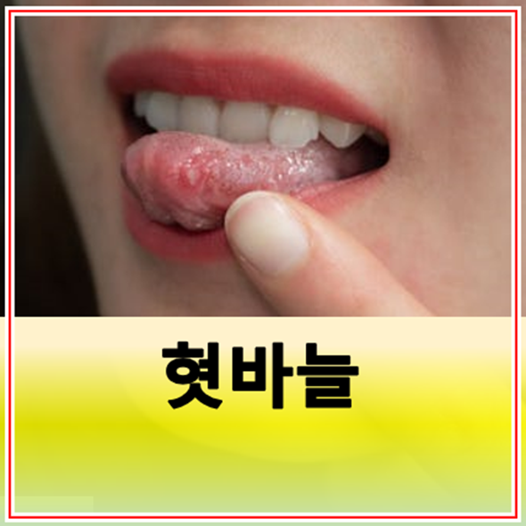 혓바늘 원인 및 약국 구입 가능한 약