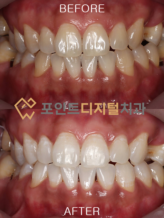  [봉명 치아미백]타치과 임플란트 중 내원하신, 30대 환자분의 치아미백(미백폭발코스 A4 → B1 극적인 변화) / 천안 아산