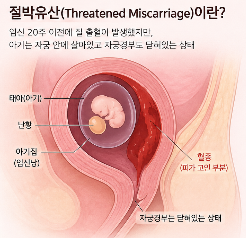 임신 5주 3일, 갑작스러운 출혈과 절박유산 진단 (+원인, 치료방법 까지)