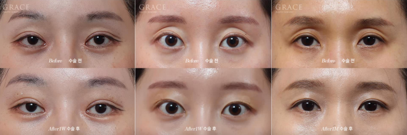 꺼진 아이홀 지방이식 유지기간과 부작용까지 알고 결정해야 하는 이유