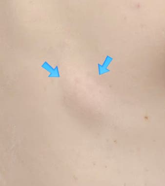 등에 혹이 생겼어요?! 지방종 제거 후기