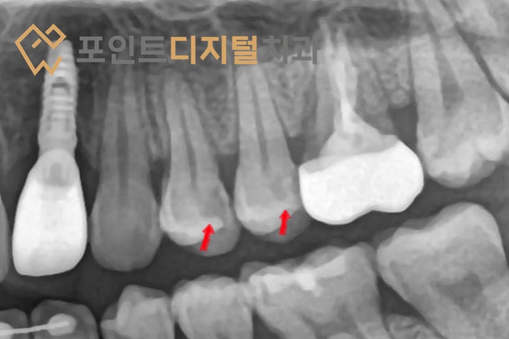 [탕정치과] 작은 어금니(소구치) 깊은 충치, MTA와 팔로덴트V3로 신경치료 없이 살리기. 레진빌드업 / 천안 아산