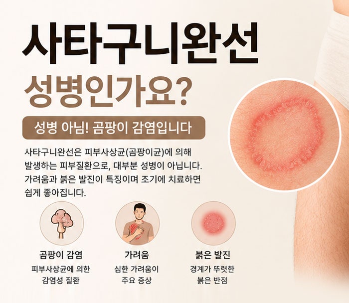 남자 사타구니 완선? 성병인가요? 이 글부터 읽어보세요