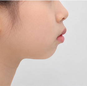 [수원 어린이 무턱 돌출입 교정] 성장기 치료가 중요한 이유