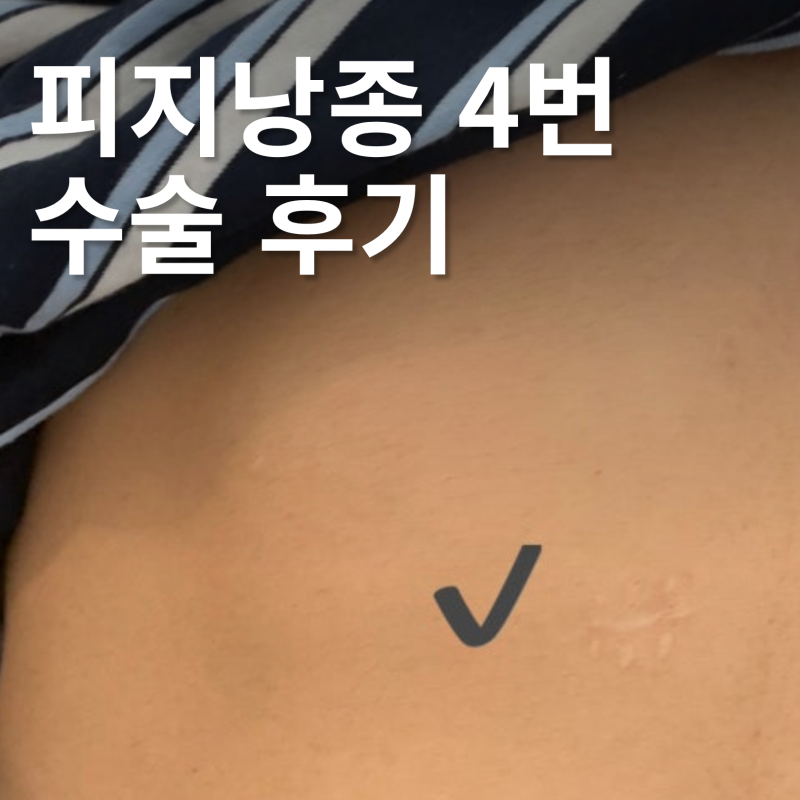 피지낭종 4번 수술한 후기 | 여드름인 줄 알고 짜면 생기는 일 (+피부과 외과 산부인과)