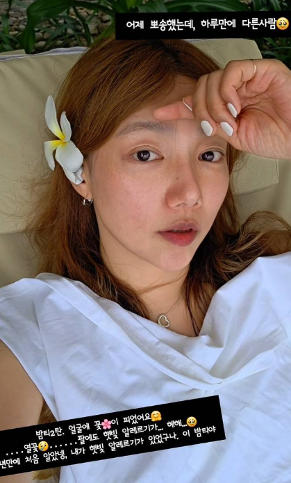  "하루 만에 얼굴이 뒤집어졌어요" 이채영도 몰랐던 '햇빛 알레르기' 정체