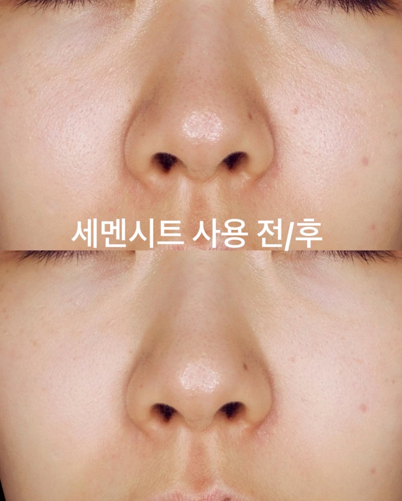코나피딜 세멘시트 카멘시트 후기 효과 사용법 35% off 공구