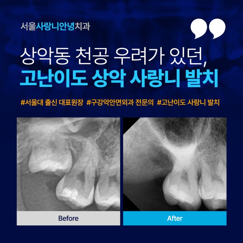 상악 사랑니 발치, 상악동 천공 우려가 있던 30대 여성 환자 후기