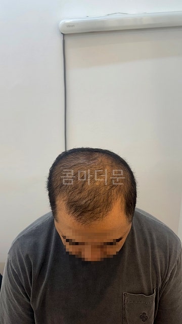 비오틴 먹으면 머리카락이 진짜 굵어질까요?