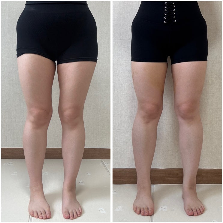  경산 허벅지지방분해주사 다이어트 오렌지케어 후기
