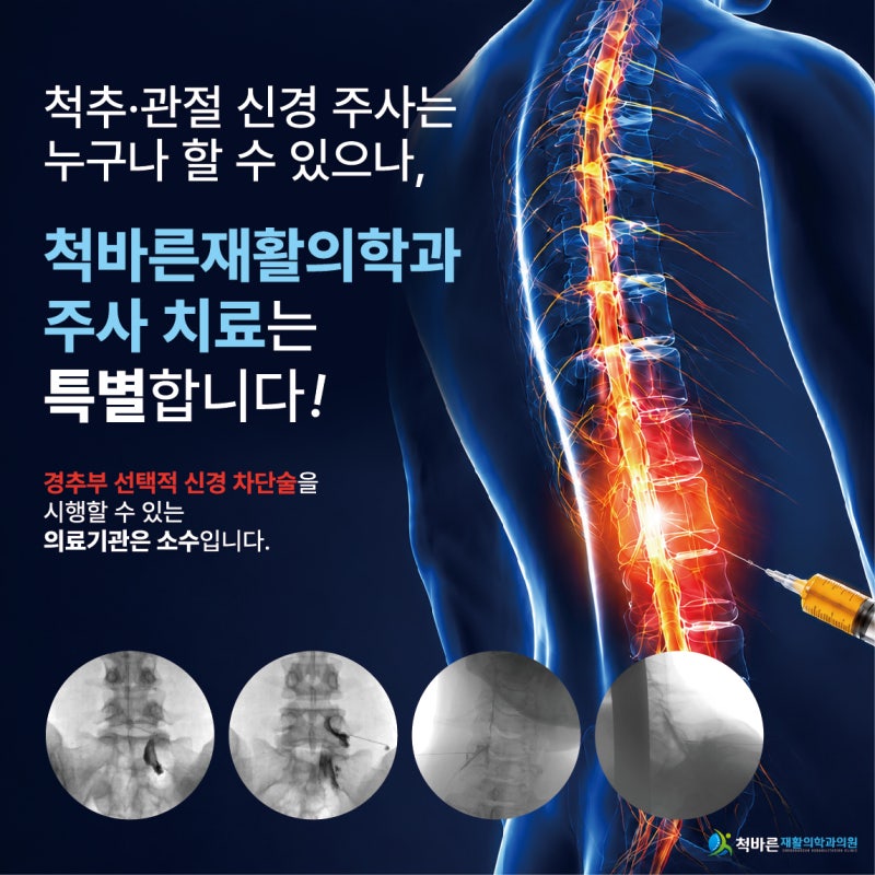 목·어깨 통증, 같은 주사가 아닙니다 — 경추부 '선택적 신경근차단술'과 '내측지차단술'의 ....
