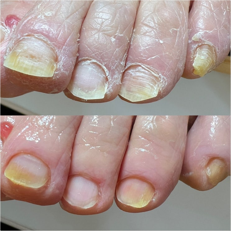  울산발톱무좀 꼼꼼했던 네일by선 페디크루